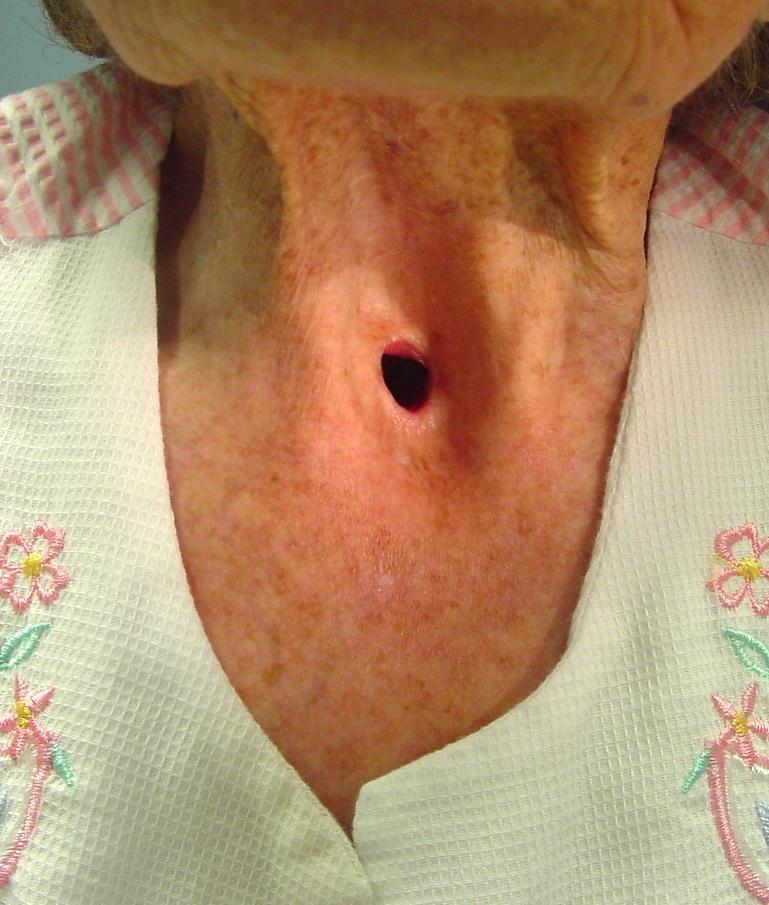 laryngectomy stoma 